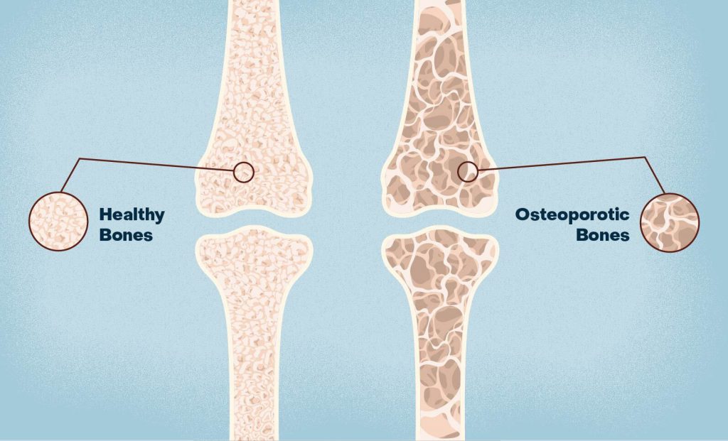 Why Calcium Matters for Bone Strength