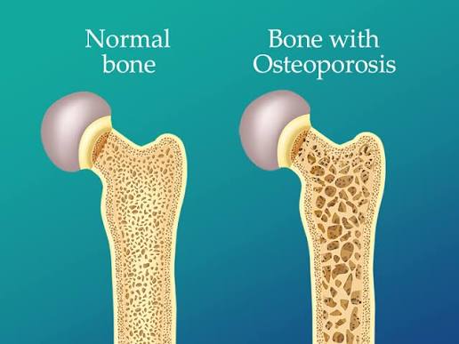 Why Calcium Matters for Bone Strength